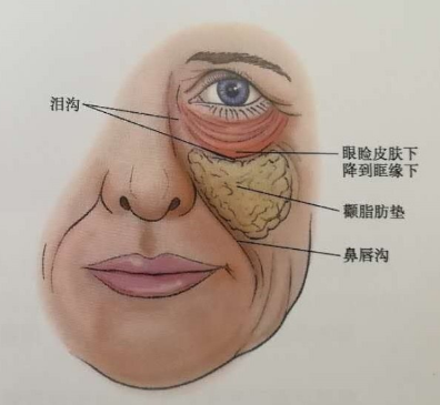 去眼袋手术