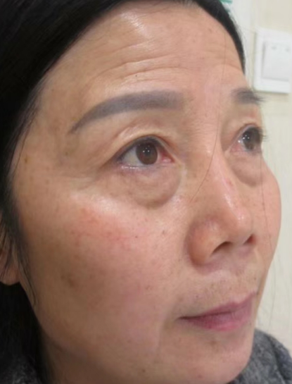 去眼袋手术