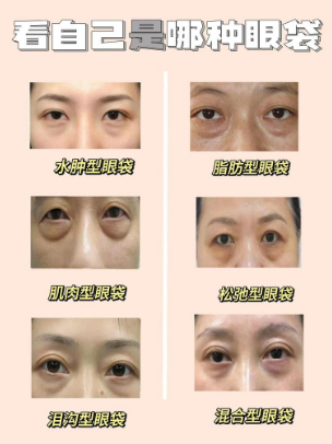 去眼袋手术