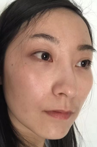 去眼袋手术