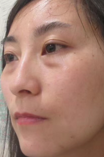 去眼袋手术