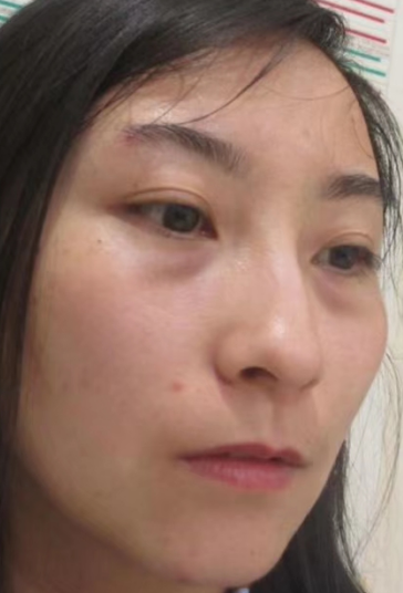 去眼袋手术