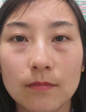 去眼袋手术