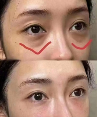 去眼袋手术