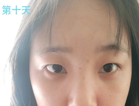 去眼袋手术