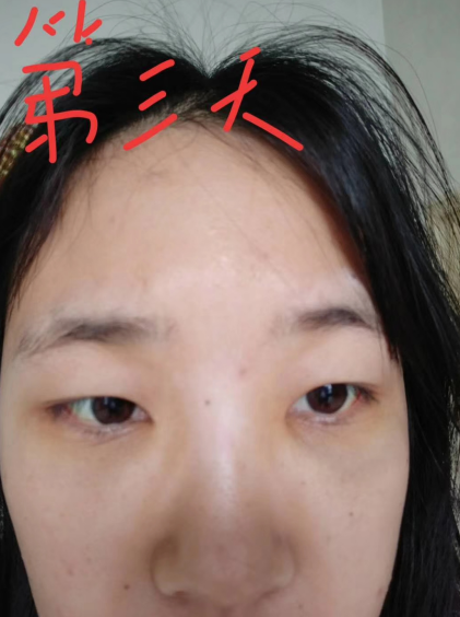 去眼袋手术