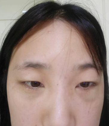 去眼袋手术