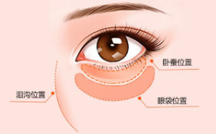 去眼袋手术