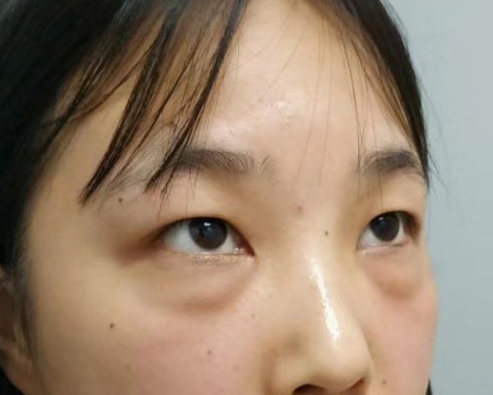 去眼袋手术