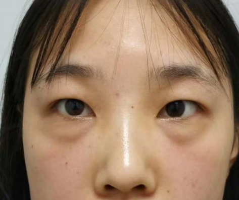 去眼袋手术