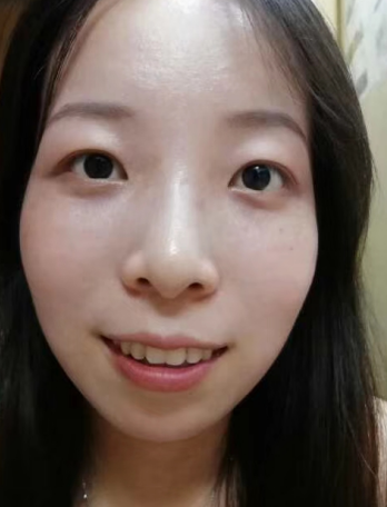 去眼袋手术
