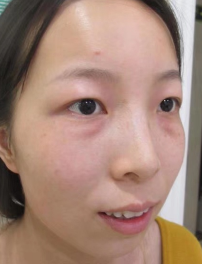 去眼袋手术