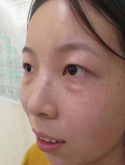 去眼袋手术