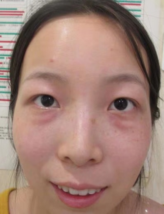 去眼袋手术
