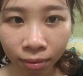 去眼袋手术