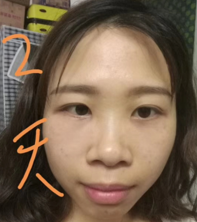 去眼袋手术
