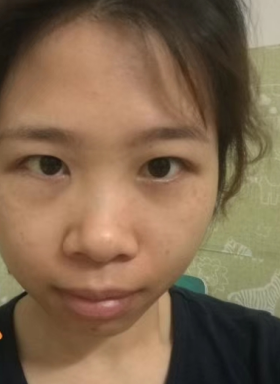 去眼袋手术