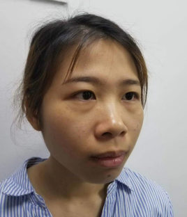 去眼袋手术
