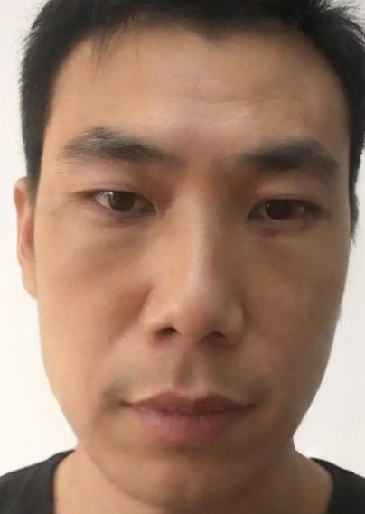 去眼袋手术