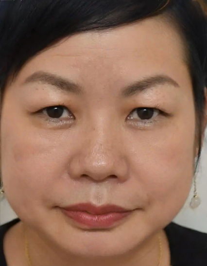 去眼袋手术