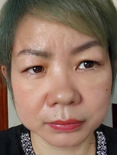 去眼袋手术