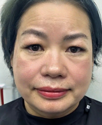 去眼袋手术