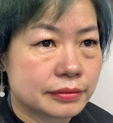 去眼袋手术