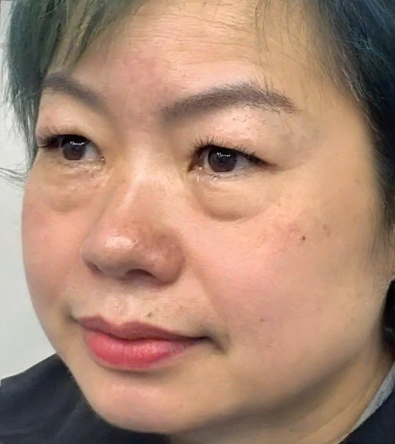 去眼袋手术