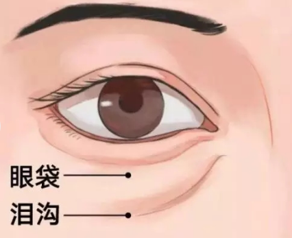 去眼袋手术