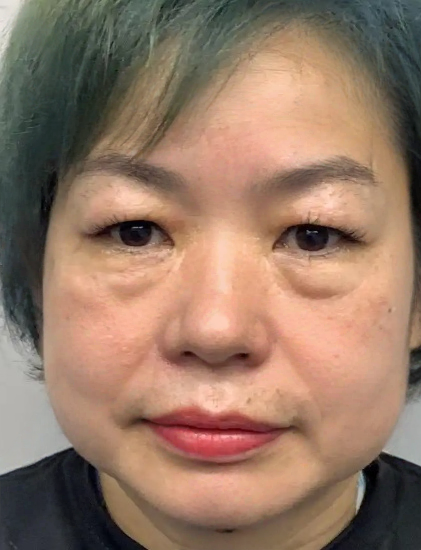 去眼袋手术