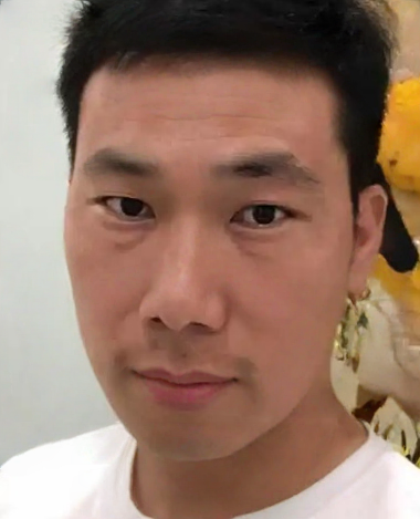 去眼袋手术