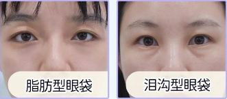 去眼袋手术