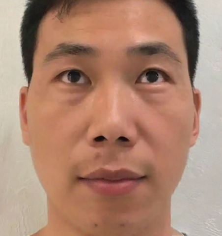 去眼袋手术