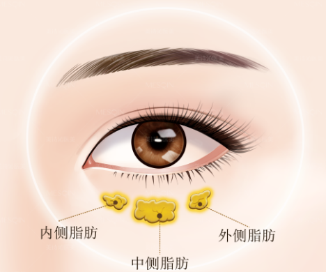 去眼袋手术