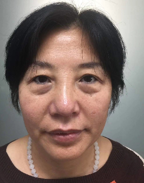 去眼袋手术
