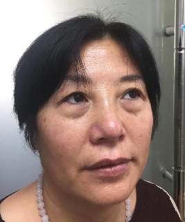 去眼袋手术