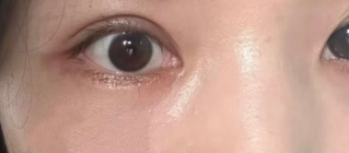 去眼袋手术