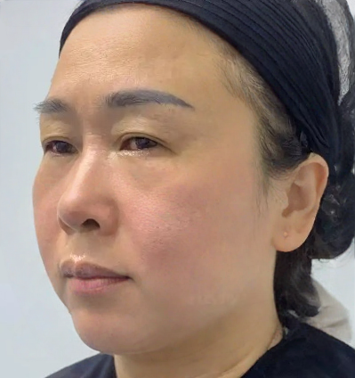 去眼袋手术