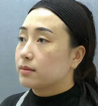 去眼袋手术