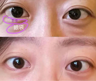 去眼袋手术