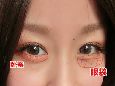 去眼袋手术