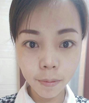 去眼袋手术