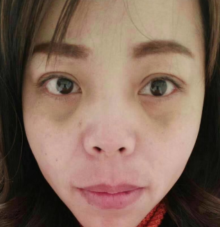 去眼袋手术