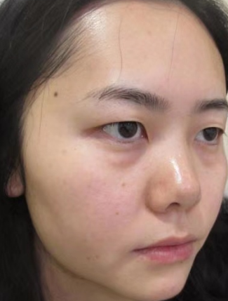 去眼袋手术