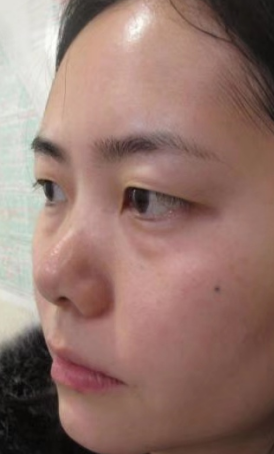 去眼袋手术