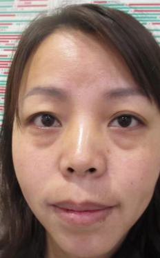 去眼袋手术