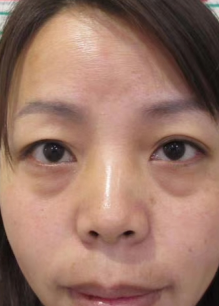 去眼袋手术