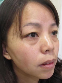去眼袋手术