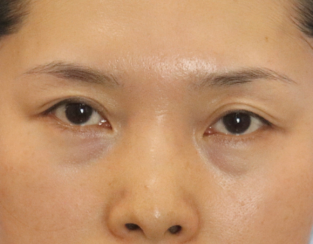 去眼袋手术