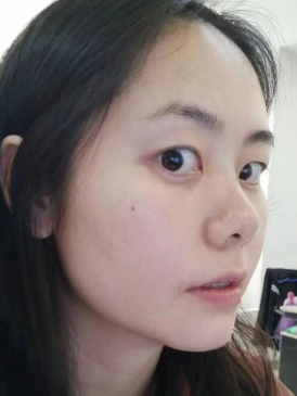 去眼袋手术